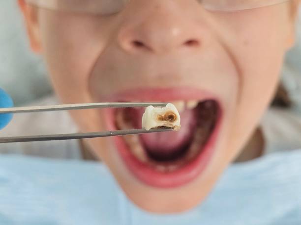 Best Emergency Treatment for Dental Infections or Abscesses in Fairview, GA