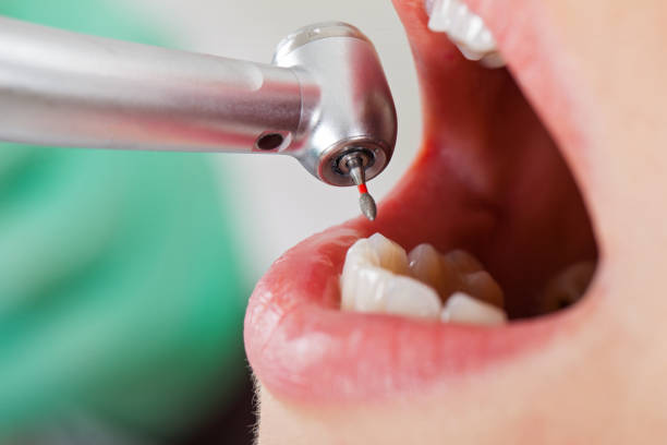 Best Emergency Dental Care for Broken or Chipped Teeth in Fairview, GA